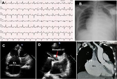 Novel pathogenic variant in LMNA gene identified in a six-generation family causing atrial cardiomyopathy and associated right atrial conduction arrhythmias